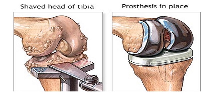 Total Knee Replacement Discharge Instructions